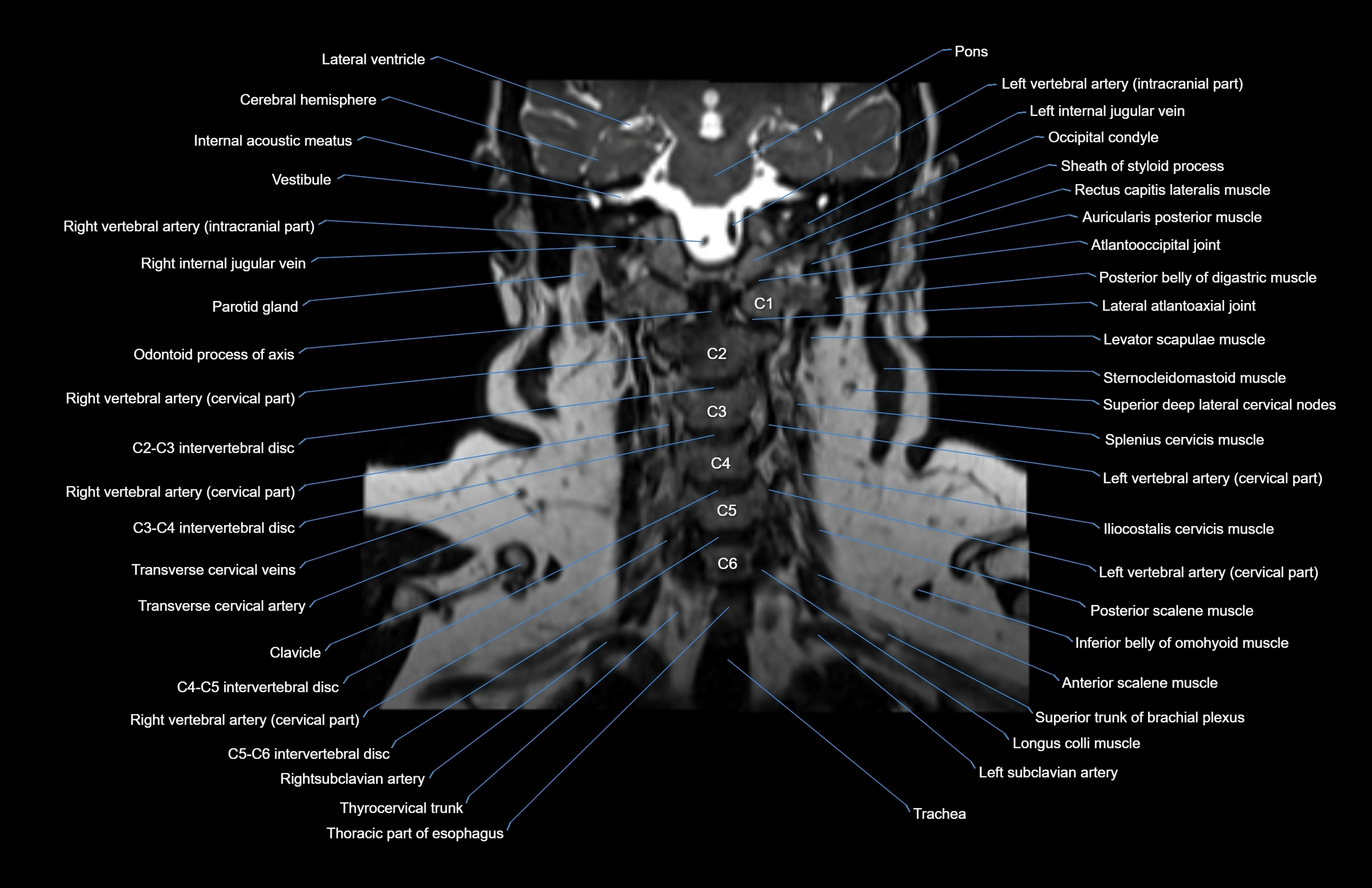 Neck coronal cross sectional MRI anatomy 3T MRI  image-img-00001-00030.webp